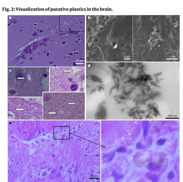 microplastics in human brain